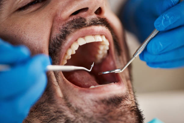 Best Emergency Wisdom Teeth Removal in Port Jervis, NY